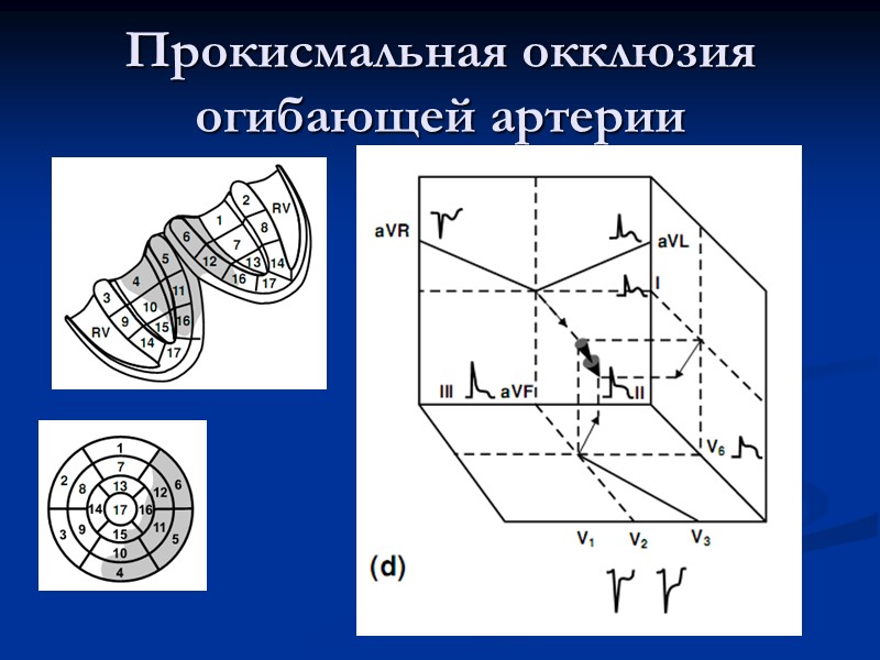 Прокисмальная окклюзия огибающей артерии